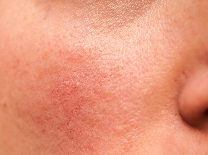 Covering Up Rosacea